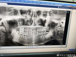 抖音视频:2024年新澳开奖结果-什么是智齿牙