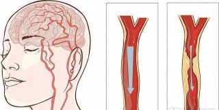 搜狗订阅:澳门正版资料免费大全精准-颈动脉斑块是什么意思