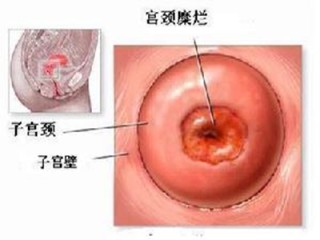 网易:2024年新奥开奖结果如何-宫颈多发纳氏囊肿是什么意思