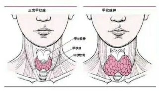 小红书:新澳精选资料免费提供-结节性甲状腺肿是什么意思