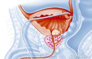 腾讯：澳门2024正版资料王中王-慢性前列腺炎有什么症状