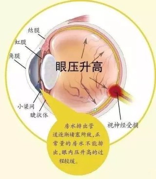 知乎：新澳门一码一肖100精确-眼压高有什么症状