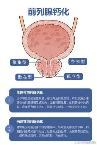 知乎：2024澳门正版平特一肖-前列腺钙化是什么原因引起的