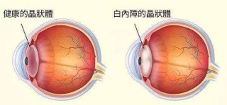 百家号:澳门三期必内必中一期-白内障是什么原因引起的