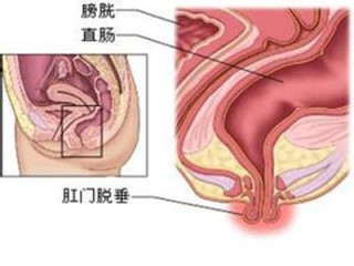 知乎：2024年新澳门内部资料精准大全-脱肛有什么症状