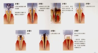 网易:澳门今日闲情免费资料-什么叫牙齿根管治疗