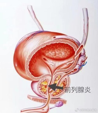 腾讯：澳门2024正版资料王中王-慢性前列腺炎有什么症状