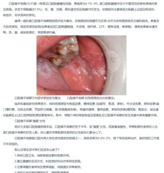 微博:新澳彩免费资料-什么是口腔扁平苔藓