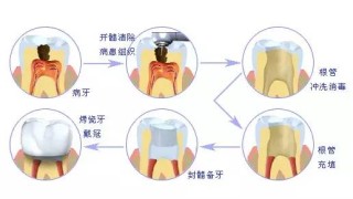 网易:澳门今日闲情免费资料-什么叫牙齿根管治疗