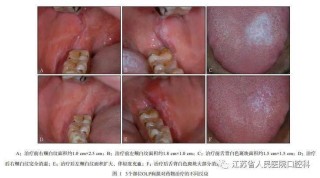 微博:新澳彩免费资料-什么是口腔扁平苔藓