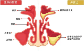 火山视频:澳门一码中精准一码免费中特-鼻炎和鼻窦炎有什么区别