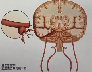 腾讯：王中王最准一肖100免费公开-蛛网膜下腔出血是什么原因引起的