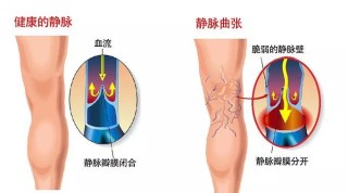 阿里巴巴:4949澳门开奖免费大全-静脉曲张有什么症状