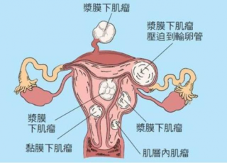 中新网:4949澳门开奖免费大全-子宫肌瘤是什么原因引起的