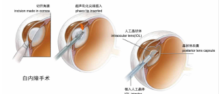 百家号:澳门三期必内必中一期-白内障是什么原因引起的