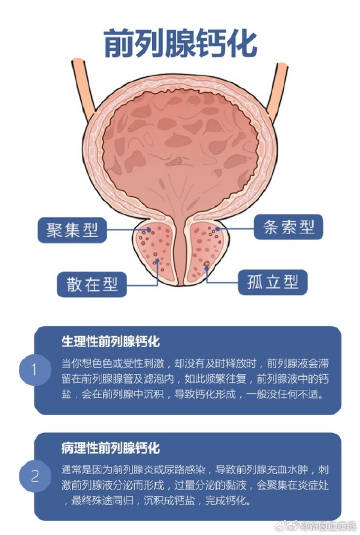 知乎：2024澳门正版平特一肖-前列腺钙化是什么原因引起的  第3张