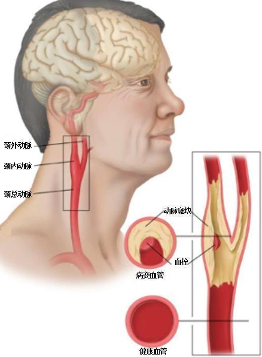 搜狗订阅:澳门正版资料免费大全精准-颈动脉斑块是什么意思  第2张