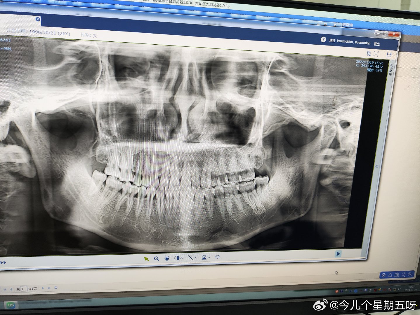 抖音视频:2024年新澳开奖结果-什么是智齿牙  第2张