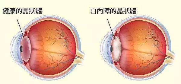 百家号:澳门三期必内必中一期-白内障是什么原因引起的  第2张