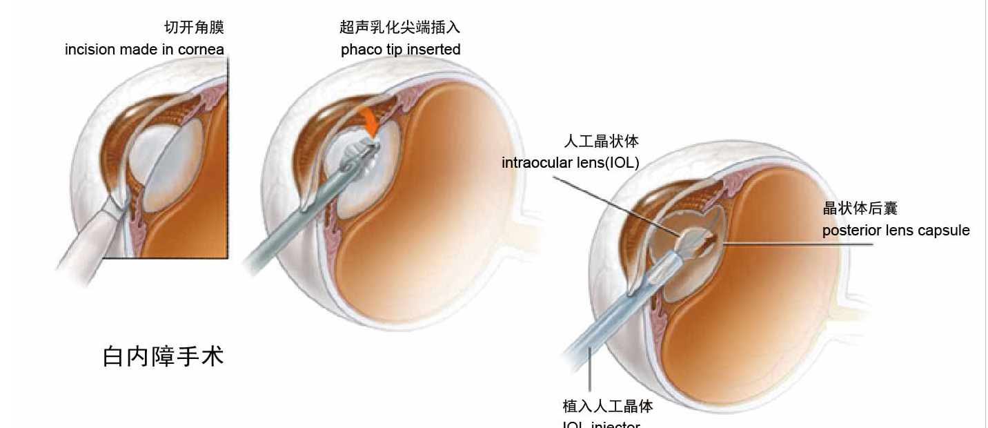 百家号:澳门三期必内必中一期-白内障是什么原因引起的  第3张