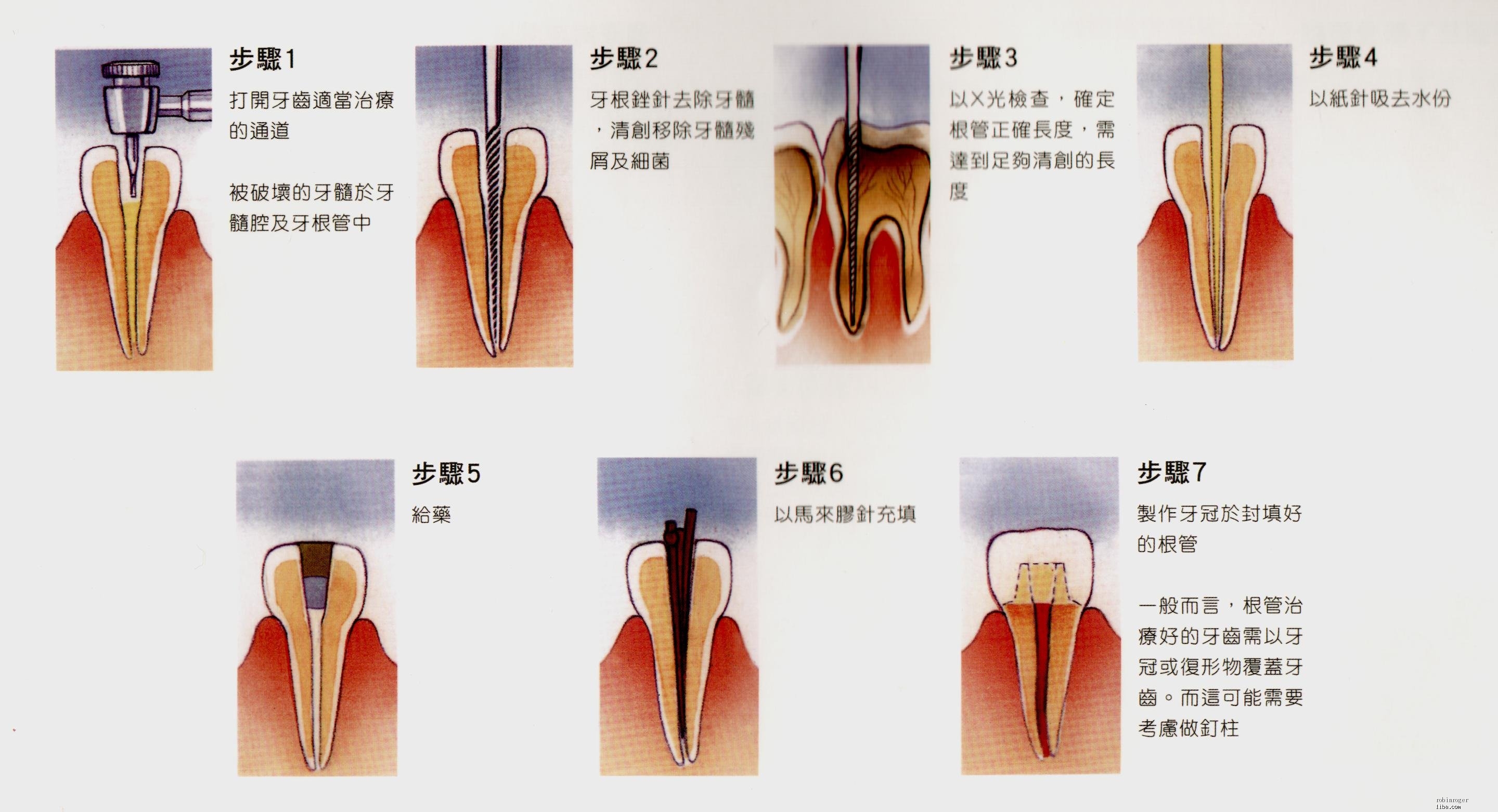 网易:澳门今日闲情免费资料-什么叫牙齿根管治疗  第1张