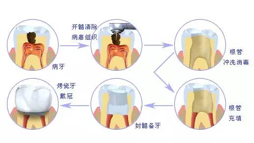 网易:澳门今日闲情免费资料-什么叫牙齿根管治疗  第2张