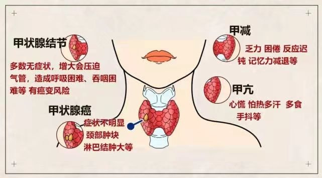 小红书:新澳精选资料免费提供-结节性甲状腺肿是什么意思  第2张