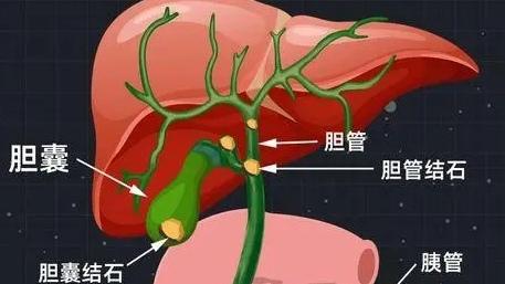 抖音视频:澳门正版资料免费更新结果查询-胆囊腺肌症是什么病  第2张