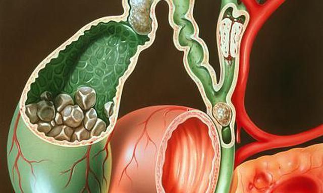 抖音视频:澳门正版资料免费更新结果查询-胆囊腺肌症是什么病  第3张