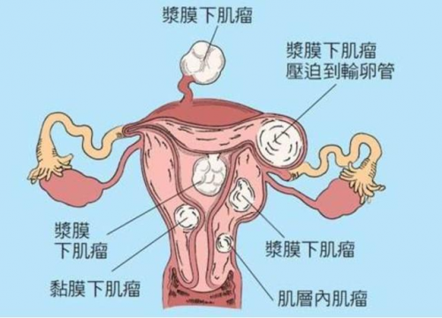 中新网:4949澳门开奖免费大全-子宫肌瘤是什么原因引起的  第3张