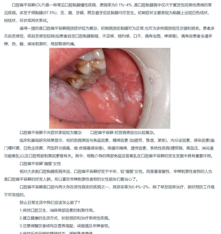 微博:新澳彩免费资料-什么是口腔扁平苔藓  第2张