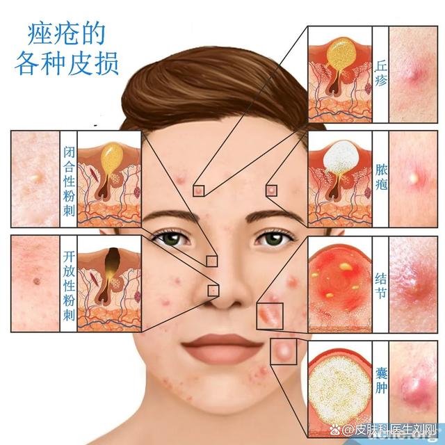 百家号:4949澳门资料免费大全高手-什么是玫瑰痤疮  第3张